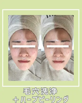 |ピーリング・毛穴| soina神楽坂のエステ・リラクイメージ