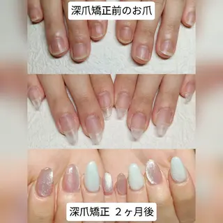 ネイル 深爪矯正/爪育成ケア manie nailのネイルデザイン