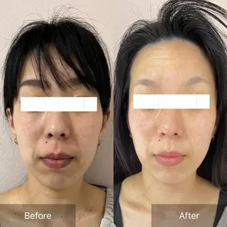 本気の小顔×毛穴ケア ／もりやま はるかのエステ・リラクイメージ