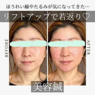 鍼灸•マッサージサロンCalfa所属・《美肌･小顔》美容鍼 ＆マッサージ＊MEIのエステ・リラクイメージ
