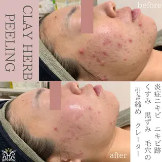 【剥離ありハーブピーリング専門エステ】cerisier BEAUTÉ 原宿所属・cerisier BEAUTÉのエステ・リラクイメージ