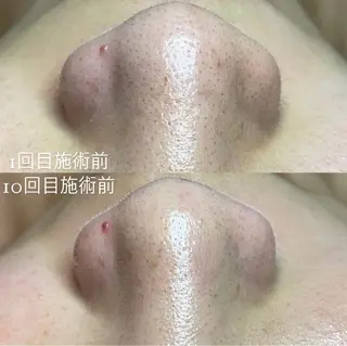 セルフエステエンリケ明石大久保店所属・夕希 毛穴と脱毛特化サロンのエステ・リラクイメージ