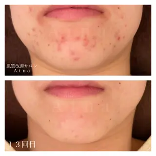 セミロング カラー パーマ ヘアアレンジ メンズ キッズ ネイル マツエク・マツパ ニキビ跡専門サロン Ainaのエステ・リラクイメージ