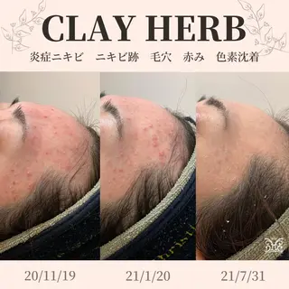 【剥離ありハーブピーリング専門エステ】cerisier BEAUTÉ 原宿所属・cerisier BEAUTÉのエステ・リラクイメージ