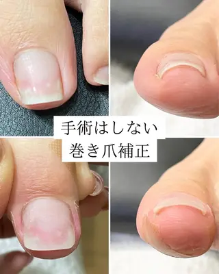 ネイル 深爪・巻き爪 専門サンセリテのネイルデザイン