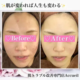 ミディアム カラー パーマ ヘアアレンジ メンズ キッズ ネイル マツエク・マツパ アイブロウ ニキビ・肌質改善専門 ♡人生が変わるサロンのエステ・リラクイメージ