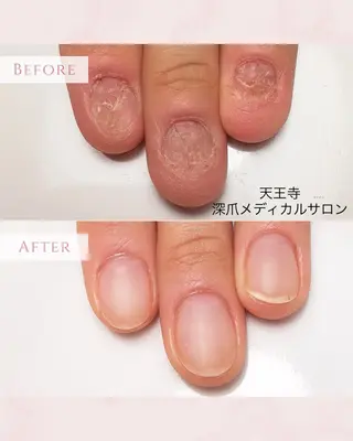 ネイル 天王寺 深爪メディカルサロンのネイルデザイン