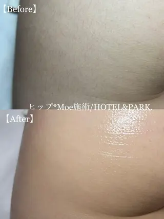 HOTEL&PARK . ワックス脱毛のエステ・リラクイメージ