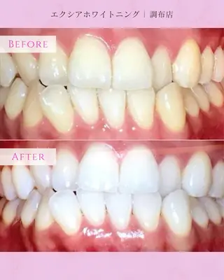 エクシアホワイト調布所属・umi❤︎ ホワイトニングのその他イメージ