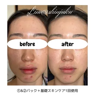 廋身·ハイパーナフ 腸·ヘッドスパ💎モのエステ・リラクイメージ