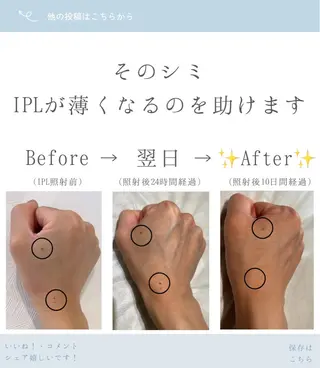 くすみ・シミ改善/ ララピール/光フォトのその他イメージ