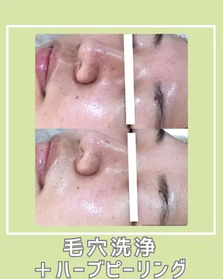 |ピーリング・毛穴| soina神楽坂のエステ・リラクイメージ