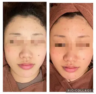 🔥3か月で肌革命 🔥ニキビ専門店のエステ・リラクイメージ