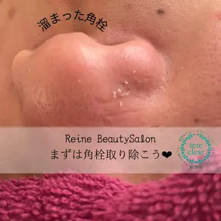 Reine BeautySalon所属・毛穴/シミ肝斑/脱毛 横山梨里のエステ・リラクイメージ