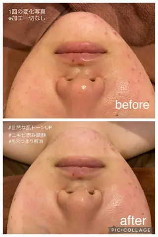 夏までに肌荒れ卒業 するサロン🌻のエステ・リラクイメージ