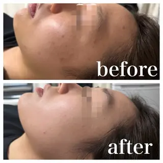 OLYMPIA所属・OLYMPIA 小顔 ハーブピーリングのエステ・リラクイメージ