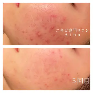 ロング カラー パーマ ヘアアレンジ メンズ キッズ ネイル マツエク・マツパ ニキビ跡専門サロン Ainaのエステ・リラクイメージ