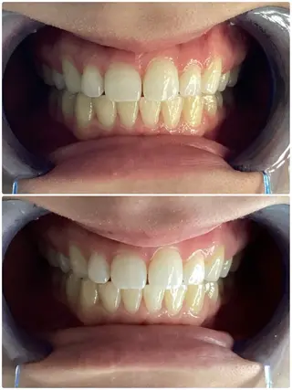 ANGEPEAU（アンジュポー）所属・セルフホワイトニング アンジュポーのその他イメージ