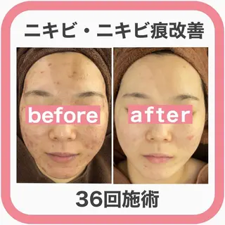 ショート カラー パーマ ヘアアレンジ メンズ キッズ ネイル マツエク・マツパ アイブロウ 🔥3か月で肌革命 🔥ニキビ専門店のエステ・リラクイメージ