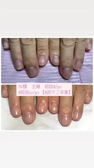 ネイル 自爪育成/深爪矯正 mikiのネイルデザイン