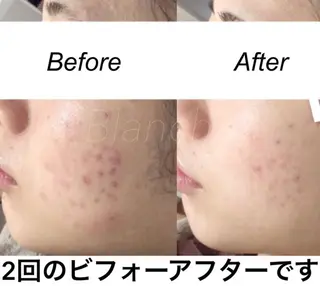 セミロング カラー パーマ ヘアアレンジ ネイル マツエク・マツパ 都度払い肌質改善 &脱毛Blancheのエステ・リラクイメージ