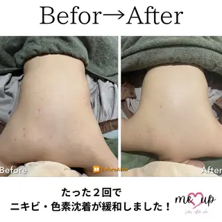 Meupニキビ専門店 背中/ハーブ/肌管理のその他イメージ
