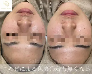 ハーブピーリング・毛穴ケア専門サロンSalon de LENA 栄店所属・ハーブピーリング専門 サロンドレナ　白藤のエステ・リラクイメージ
