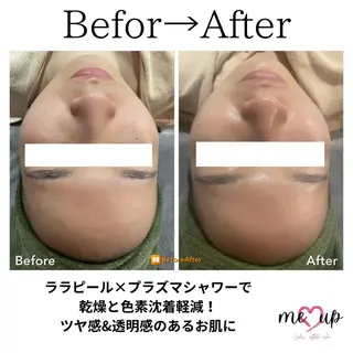 Meupニキビ専門店 背中/ハーブ/肌管理のその他イメージ