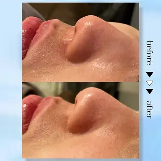 ☆痩身/小顔☆ ハイパーナイフexのエステ・リラクイメージ