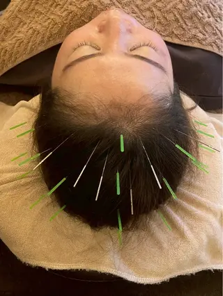 Acupuncture  salon LINOA リノア鍼灸院所属・LINOAヘッドスパ 小顔ケア/逆子ケアのエステ・リラクイメージ