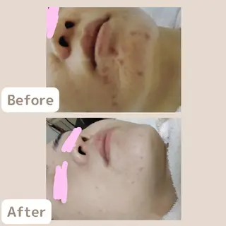 レチノール/ニキビ/ 毛穴ケア　浅川のエステ・リラクイメージ