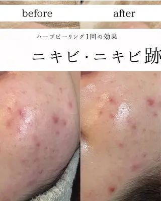 yc.hacci 【ハーブピーリング】のエステ・リラクイメージ