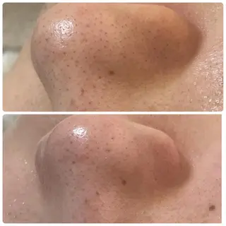 ネイル マツエク・マツパ アイブロウ ニキビ・毛穴改善 🌿ハーブピーリングのエステ・リラクイメージ