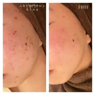 セミロング カラー パーマ ヘアアレンジ メンズ キッズ ネイル マツエク・マツパ ニキビ跡専門サロン Ａｉｎａのエステ・リラクイメージ