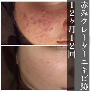 ショート メンズ キッズ マツエク・マツパ ネイル アイブロウ カラー パーマ ヘアアレンジ ニキビ跡改善専門🔥 医療にはできない改善のエステ・リラクイメージ