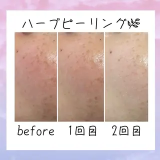 メンズ 肌質改善Charme coco  増毛のエステ・リラクイメージ