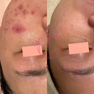 【ニキビ/肌管理】 salon varyのエステ・リラクイメージ