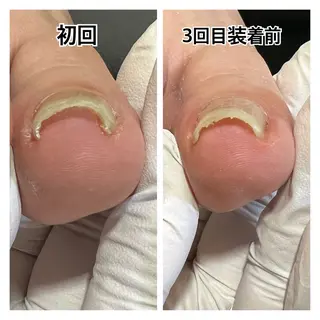 ネイル 巻き爪補正店 堺東店のネイルデザイン