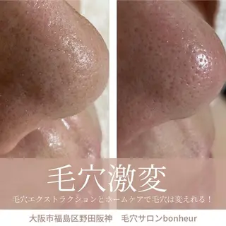 毛穴ケア・肌質改善 徳川のエステ・リラクイメージ