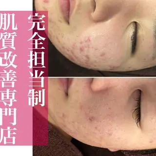 ミディアム カラー パーマ ヘアアレンジ メンズ キッズ ネイル マツエク・マツパ ニキビ・肌質改善専門 ♡人生が変わるサロンのエステ・リラクイメージ