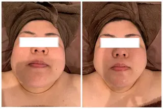 Chalon所属・REVI取扱・肌悩み 毛穴Chalonのエステ・リラクイメージ