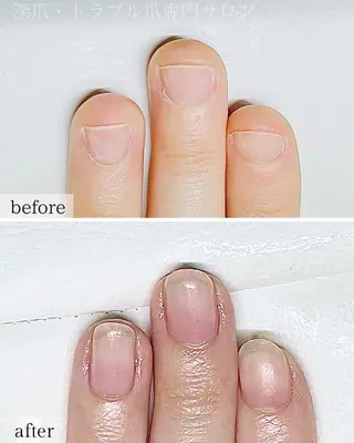 ネイル 深爪・巻き爪 専門サンセリテのネイルデザイン