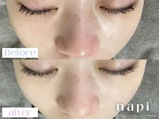 ハーブピーリング 専門店napiのエステ・リラクイメージ