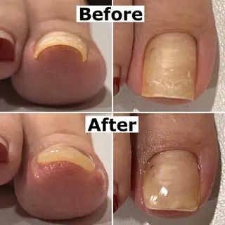 ネイル Mellow nail所属・巻爪無料モデル募集 ✨🦶MEGUMIのネイルデザイン