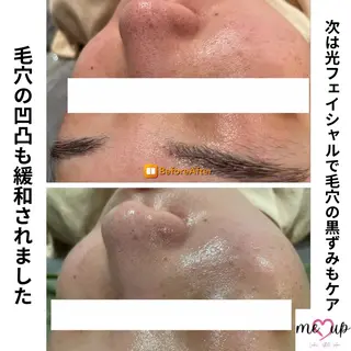 Meupニキビ専門店 背中/ハーブ/肌管理のその他イメージ