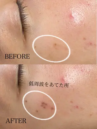 シミケア/ハーブピーリング/脱毛/小顔フェイシャル/ハーブ温浴　LAULEA所属・素肌をキレイに ラウレア🌼Hayaのエステ・リラクイメージ