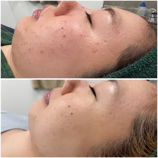 BLANC.【新宿店】所属・ハーブピーリング ayamiのエステ・リラクイメージ