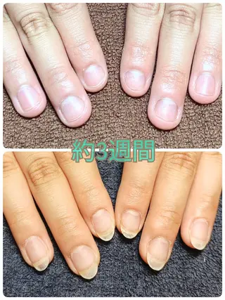 ネイル 深爪矯正/爪育成ケア manie nailのネイルデザイン