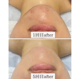 ハーブピーリング🌹 Homieのエステ・リラクイメージ