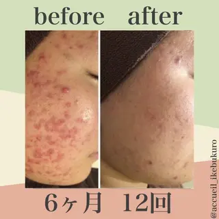 夏までに肌荒れ卒業 するサロン🌻のエステ・リラクイメージ